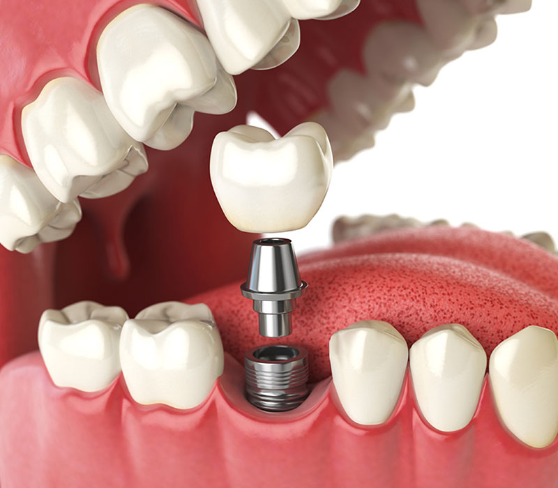 dental implants in York