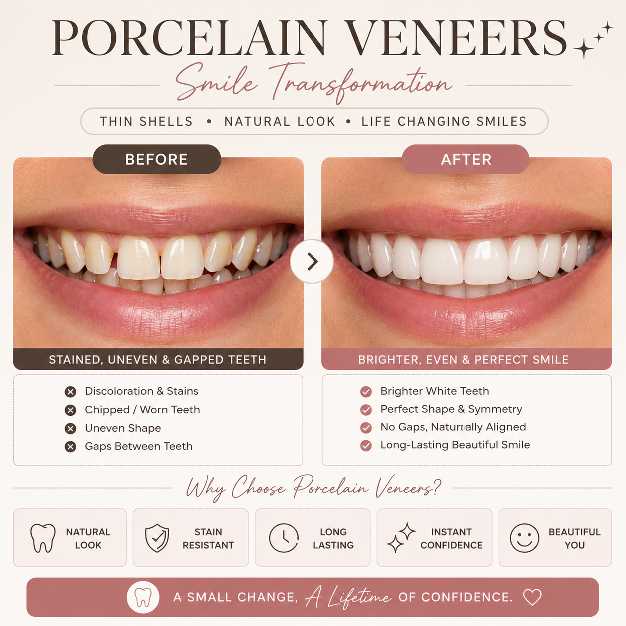 dental veneers near me