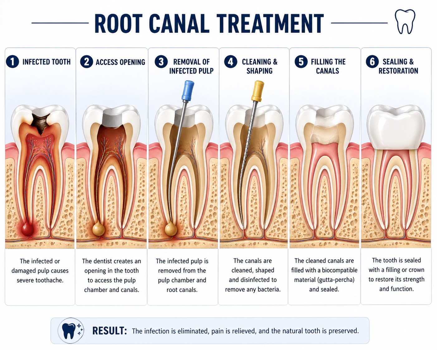 root canal treatment near me