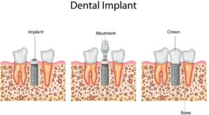 dental implants 