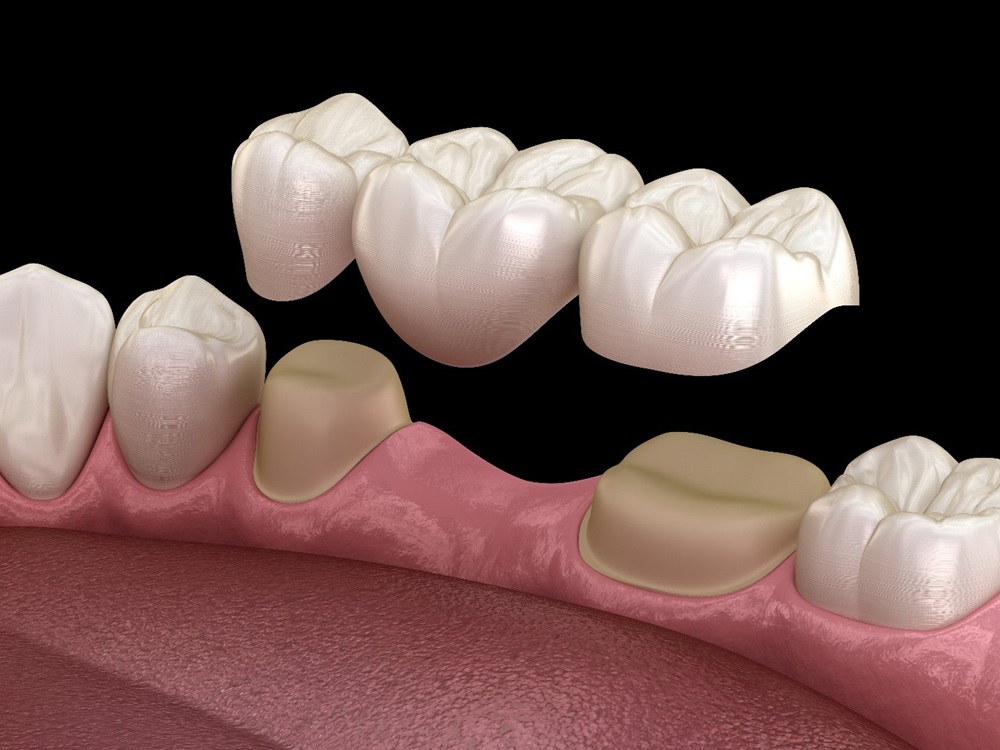 dental bridges in York