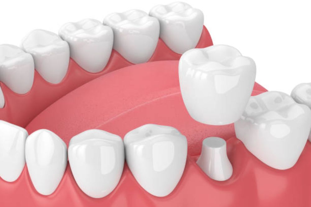 Dental Crowns in York