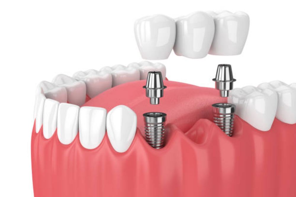 Dental bridge vs implant comparison chart York