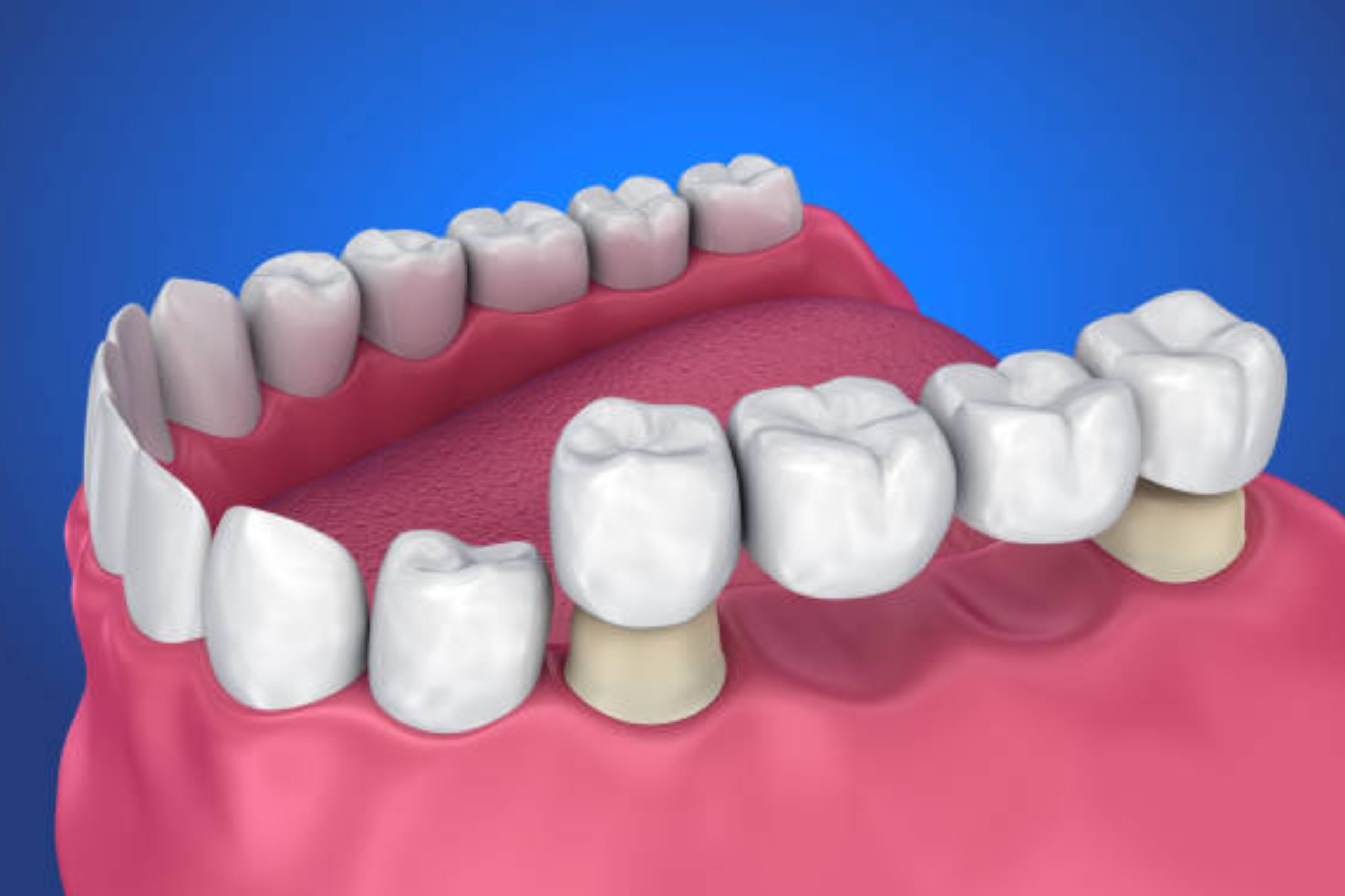 Dental crown procedure being performed by a dentist