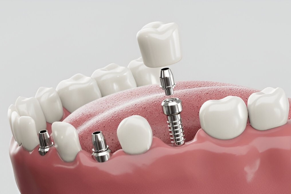 What Are Dental Implants? – How They Replace Missing Teeth Near You